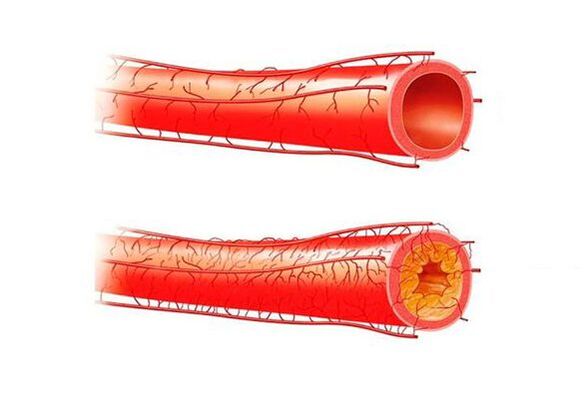 Problems with potency due to blood vessels